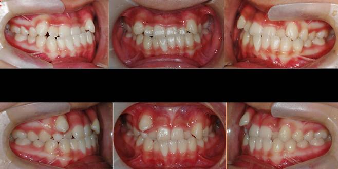 거울상(mirror image)을 보이는 일란성 쌍둥이의 치열