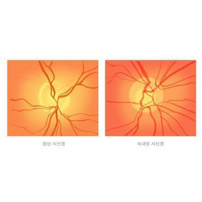 정상 시신경(왼쪽)과 녹내장 시신경(오른쪽) [출처: 삼성서울병원]