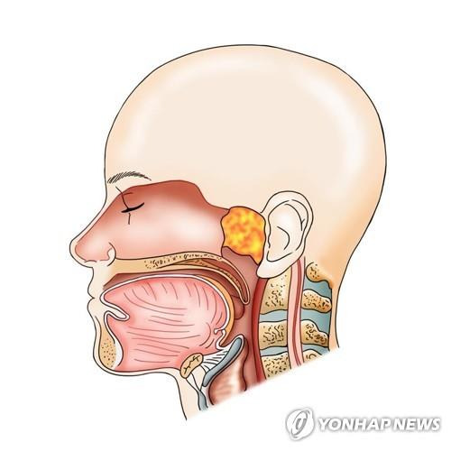 두경부암 [연합뉴스 자료사진]