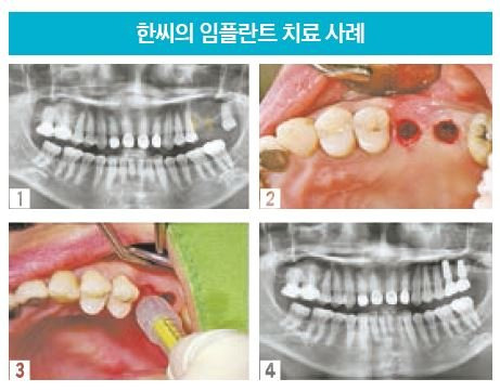 1.잇몸뼈 두께가 1㎜밖에 되지 않아 다른 치과에서 임플 란트 식립 불가 판정을 받은 환자의 구강 모습. 2,3.임세 웅 원장이 특수 주사기로 잇몸 절개 없이 인공 뼈를 주입 하는 모습. 4.임플란트 수술 후 6개월이 지난 환자의 구 강 상태. [사진 더와이즈치과병원]