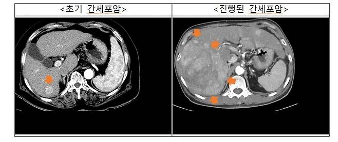 간세포암 영상(CT)  [국민건강보험공단 제공. 재판매 및 DB 금지]