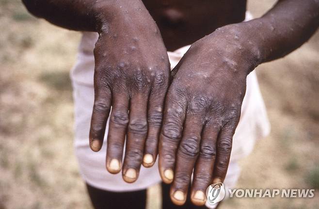 민주콩고공화국 원숭이두창 환자의 손 표면 [AP=연합뉴스 자료사진]