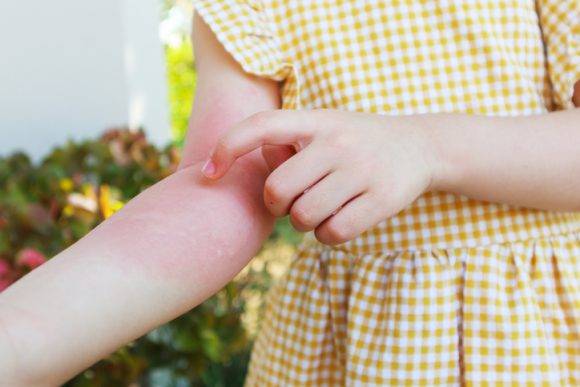 땀띠는 땀구멍이 막혀 발생하는 염증의 하나로 좁쌀 만한 발진이나 홍반을 말한다. [사진= 게티이미지뱅크]