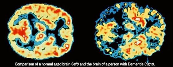 정상인의 뇌(왼쪽)와 치매 환자의 뇌.