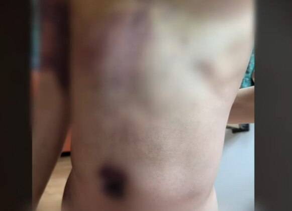 지난달 초 충북 청주의 장애인 재활시설에서 사회복지사로부터 폭행당한 지적장애 등 1급 장애인의 몸통에 멍이 든 모습. /KBS충주