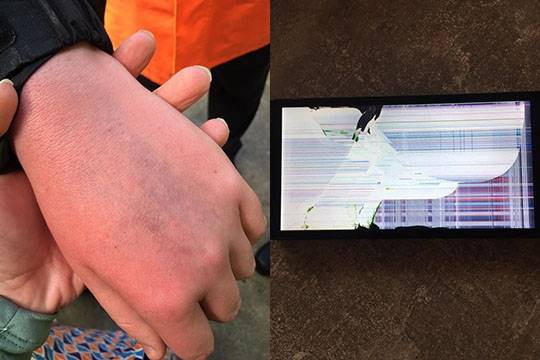 호날두로부터 손을 맞은 소년팬 제이크 하딩의 손등(왼쪽)에 멍이 들어있다. 호날두가 내려친 휴대전화(오른쪽)는 바닥에 떨어져 파손됐다. 제이크 하딩의 어머니 사라 켈리 소셜미디어 캡처