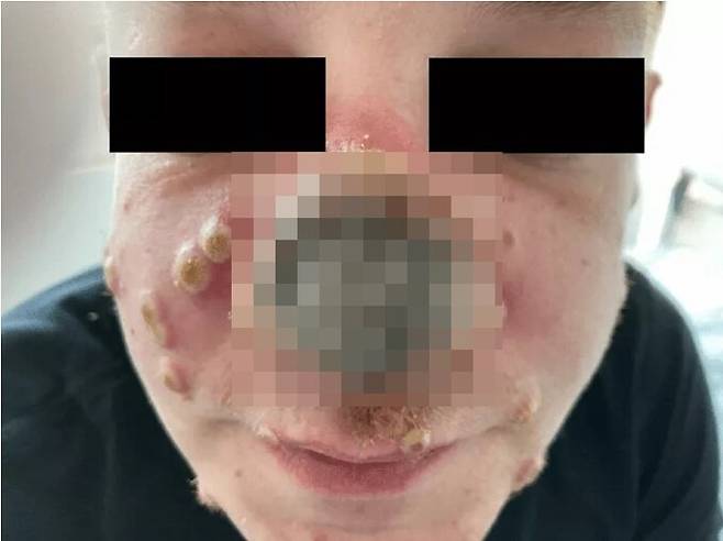 원숭이두창에 걸려 코가 괴사된 40대 독일 남성. 뉴스위크 캡처