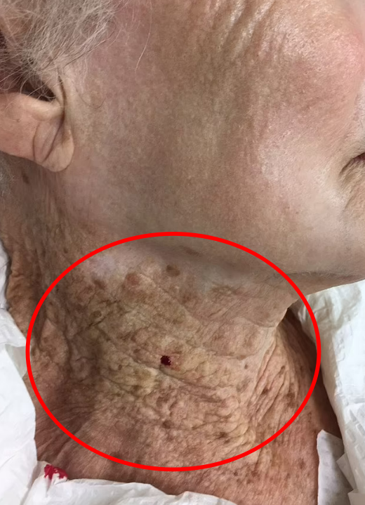 40년 간 선크림을 얼굴에만 바르고 목에는 바르지 않은 92세 여성의 사례가 국제학술지에 소개됐다