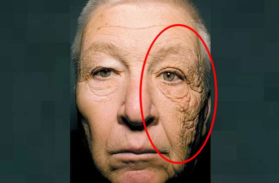 28년간 화물차 운전을 하며 한쪽 얼굴만 자외선에 노출돼 광노화가 발생한 남성의 얼굴.  2012년 의학 저널 뉴잉글랜드 저널 오브 메디슨지(New England Journal of Medicine) 사례