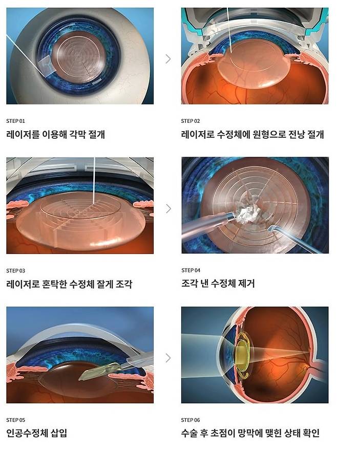 출처:비앤빛강남밝은세상안과