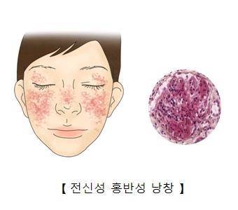 루푸스(전신 홍반성 낭창] [출처: 서울아산병원]