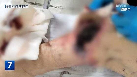 무릎이 괴사된 서귀포공립요양원 입소자. 사진 KBS 뉴스 화면 캡처
