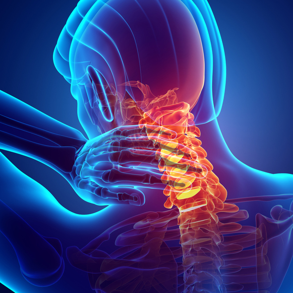 경수증은 신경다발인 척수가 지나는 경추강으로 디스크가 탈출하거나 노화로 생긴 골극(뼈의 가장자리 웃자란 뼈)이 경추강을 막거나 압박하면서 발생한다. /게티이미지뱅크