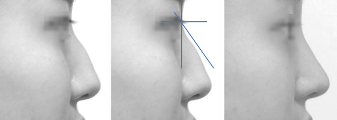 가성 매부리, 콧대는 예쁜데 코끝만 떨어져 있다. 코끝만 높여주면 된다.