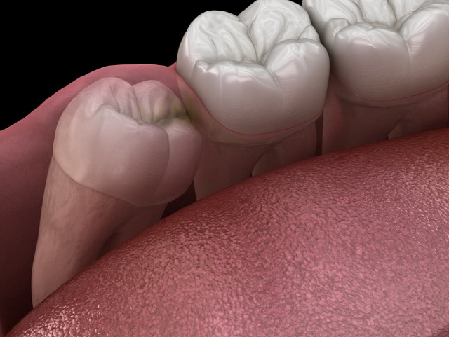 사랑니를 뽑으면 미각이 최대 10% 향상한다는 연구 결과가 나왔다./사진=게티이미지뱅크