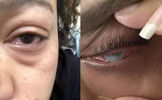 잘못된 렌즈 착용으로 한쪽 눈이 실명된 키라의 모습.