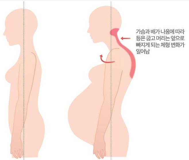 임신 전후 체형변화. 배가 불러오면서 허리가 앞으로 나오고 등은 뒤로 눕는다. 리셋재활의학과 제공