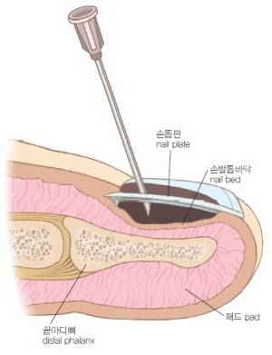 손발톱의 혈종 제거/사진=<해부학>(박억숭 공저/수문사)