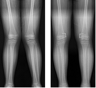 외반슬(엑스자 다리)에 대해 8자 금속판 이용한 대퇴골 내측 반성장판 유합술 후 교정된 환자(좌- 교정 전, 우-교정 후).