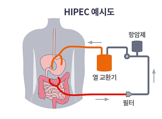 하이펙 치료 개념도 [자료=분당차병원 하이펙센터]