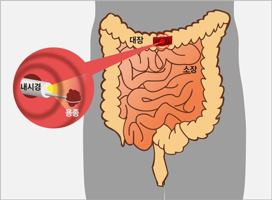 대장암 예방을 위해서는 정기 내시경 검사가 중요하다. 사진=강동경희대병원 제공