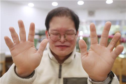 선천적 기형 가진 손 보여주는 김경석씨 [촬영 윤태현]