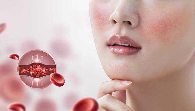 안면홍조는 얼굴 피부가 열감과 함께 일시적으로 붉게 달아오르는 질환이다./사진=클립아트코리아