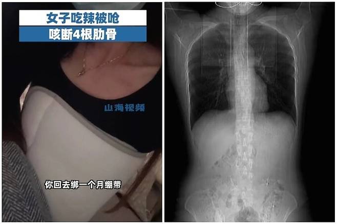 기침을 심하게 했다가 갈비뼈 4대가 부러진 황모씨(왼쪽)와 그의 CT 촬영 필름. SCMP 캡처