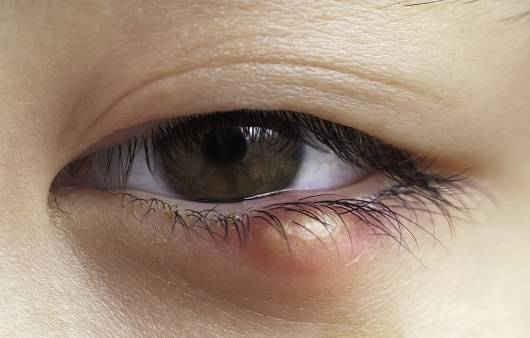 다래끼｜출처: 게티이미지 뱅크