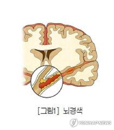 뇌경색 [출처: 서울아산병원]