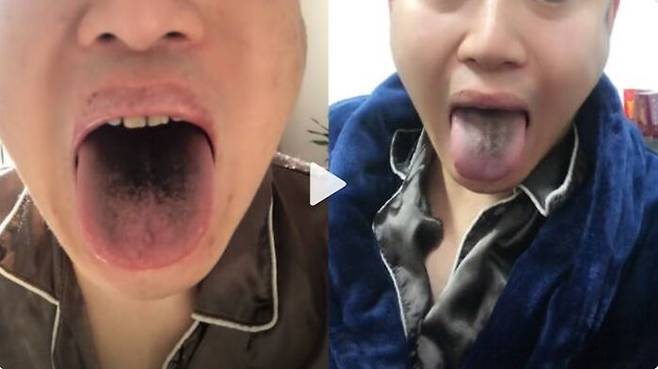 중국 톈진의 한 남성은 코로나19에 감염된 뒤 혀가 검게 변했다고 주장했다.(사진=웨이보 캡처)