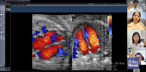 보호자와 산모, 2차 의료기관(미즈메디병원 전진동 진료부장), 세브란스병원(권하얀 산부인과 교수) 주치의가 산모의 초음파 검사 결과를 함께 보며 협진을 하는 모습. ⓒ세브란스병원