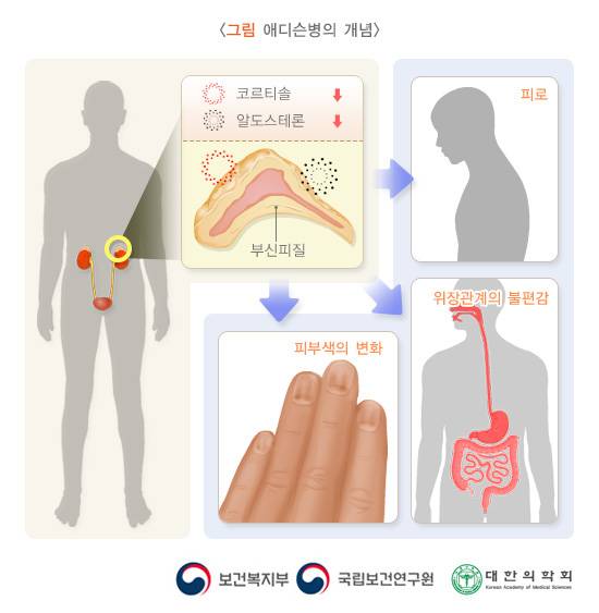 애디슨병 개념도 [자료=질병관리청 헬프라인]