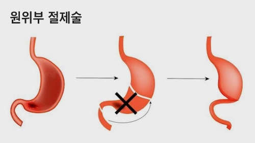 비교적 초기 위암일 때 시행하는 수술법 중에서 위 아랫부분 3분의 2를 절제하고 남은 위를 소장과 연결하는 원위부 절제술. /자료=서울대병원