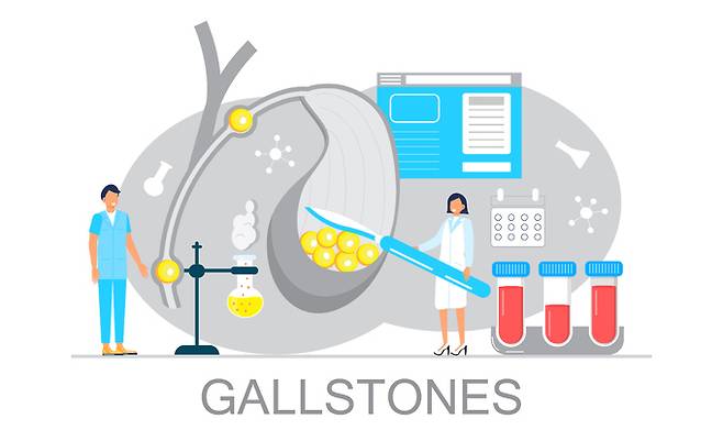 담석증. 게티이미지뱅크