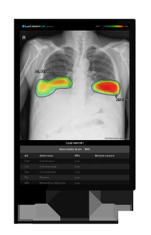 루닛 흉부 엑스레이 AI 영상분석 솔루션 ‘루닛 인사이트 CXR’ (사진=루닛)