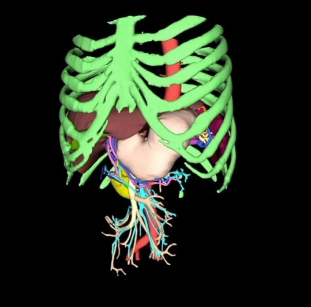 CT 사진을 바탕으로 휴톰이 딥러닝 기술로 3차원 그래픽으로 재현한 환자의 위 주변 혈관 분포. 사람마다 조금씩 다른 혈관이 놓인 위치나 모양을 놓치지 않고 재현함으로써  혹시 있을 수 있는 잘못된 혈관 절단 사고를 미연에 방지한다.