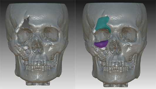 외상으로 발생한 골 결손(왼쪽)과 컴퓨터 시뮬레이션을 통해 골 결손이 생기기 전 상태로 만들어 낸 환자 맞춤형 인공뼈. 사진 제공=고려대안암병원