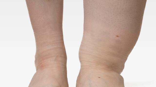 한쪽 다리만 심하게 붓는다면 심부정맥혈전증을 의심할 필요가 있다./사진=게티이미지뱅크