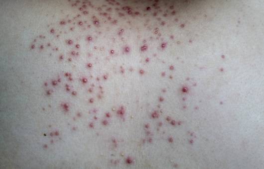 모낭염ㅣ출처: 게티이미지뱅크