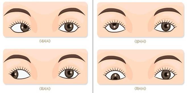 사시 종류ㅣ출처: 보건복지부