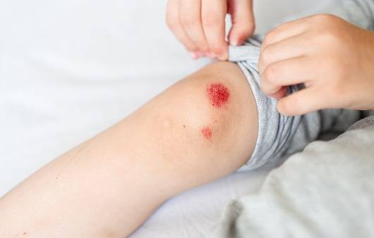 상처는 잘 조치하지 않으면 흉터가 남는다ㅣ출처: 게티이미지뱅크