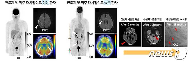 예후가 서로 다른 급성 뇌졸중 환자의 양전자 단층 촬영 검사 결과/서울대학교병원 제공