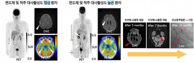 예후가 서로 다른 급성 뇌졸중 환자의 양전자 단층 촬영 검사 결과. 서울대병원 제공