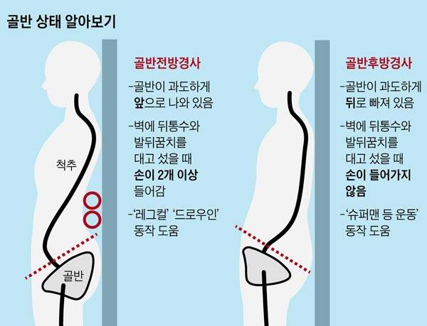 뒤통수와 발뒤꿈치를 벽에 붙이고 서서 허리 뒤쪽과 벽에 있는 공간 사이에 손을 넣었을 때 두 손이 다 들어가면 앞쪽으로 골반이 틀어진 '골반전방경사'를 의심해볼 수 있다./그래픽=헬스조선DB