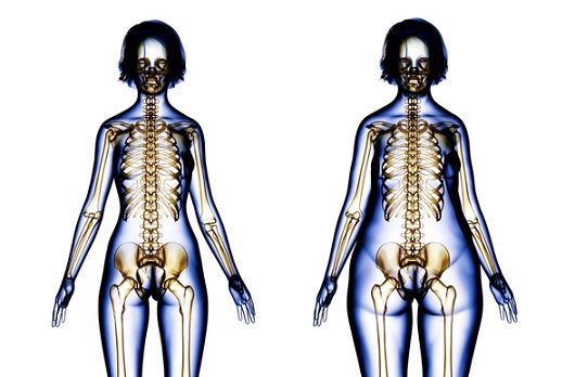 뼈가 가늘고 체중이 적게 나가는 사람은 골다공증 발생 위험이 크다ㅣ출처: 게티이미지뱅크