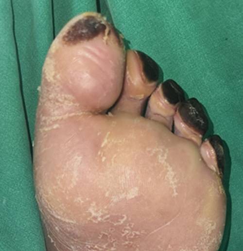 검은 부분이 괴사된 조직.