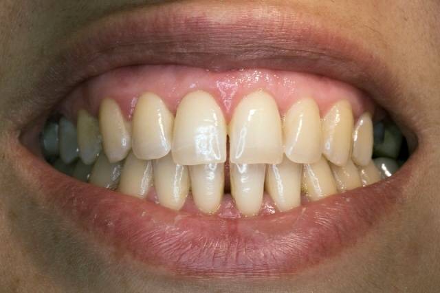 양치와 상관 없이 유전적인 원인이나 특정 음식 섭취, 항생제 복용 등에 의해 치아가 누렇게 변할 수 있다./사진=클립아트코리아