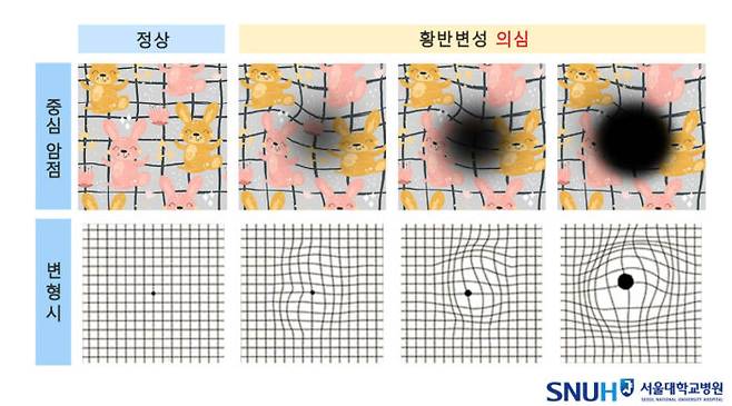 대표적인 황반변성 전조증상 2가지의 예시. 사물의 중심이 보이지 않는 '중심 암점'과 사물이 휘어 보이는 '변형시'. [자료=서울대병원]