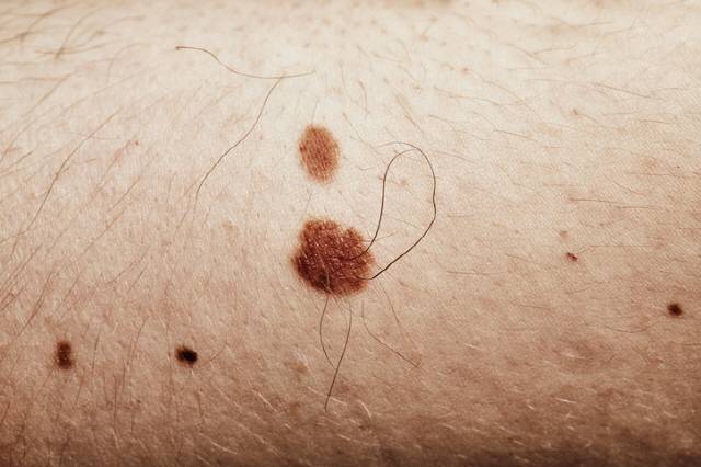 양성종양인 점에 있는 모근은 조직 이상 탓에 주변 모근보다 털이 길고 굵게 자랄 수 있다./사진=게티이미지뱅크